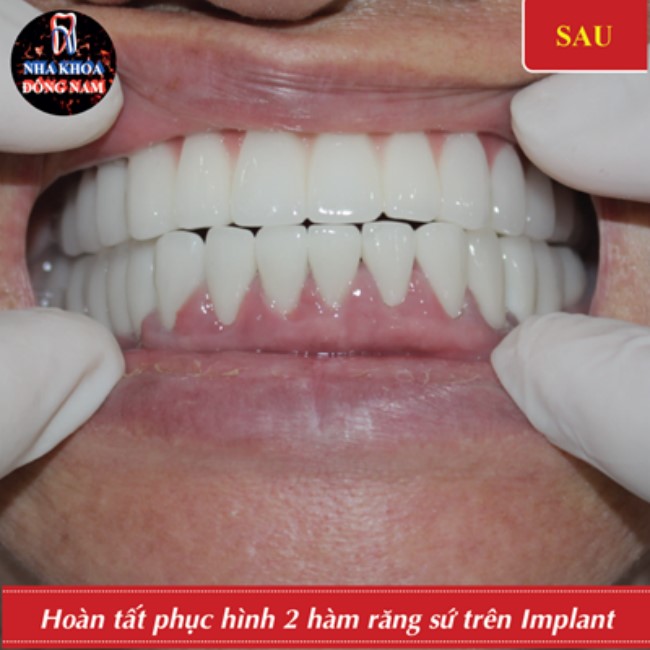 cấy ghép implant thay thế cầu răng sứ 2 hàm bị hỏng 6