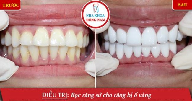 Phục hình răng sứ cho răng bị vàng răng