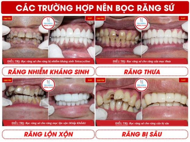 Các trường hợp phục hình răng sứ tại nha khoa Đông Nam