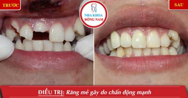 Làm răng sứ cho răng bị hư tổn