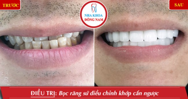 Làm răng sứ cho răng mọc lệch