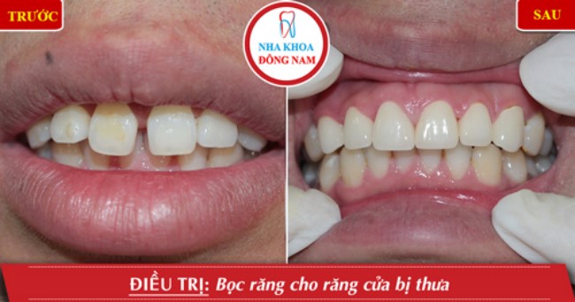 Phục hình răng sứ cho răng thưa