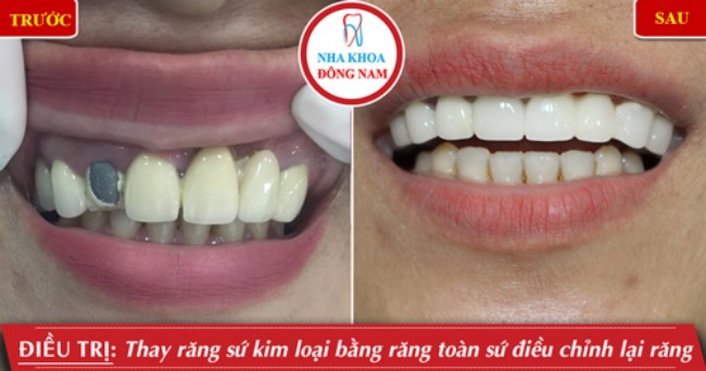 Phục hình sứ cho răng bị đen viền nướu