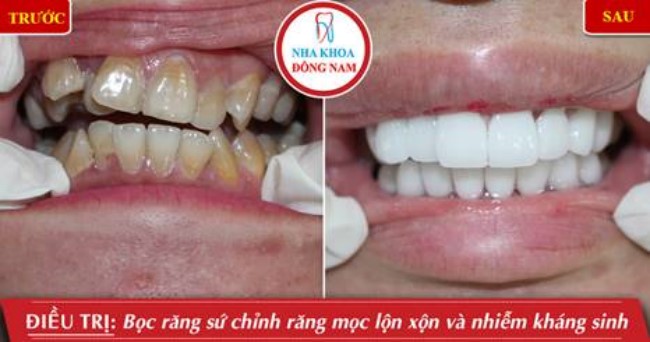 Phục hình răng sứ cho răng bị nhiễm kháng sinh