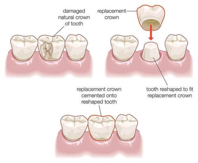 Quy trình làm răng sứ thẩm mỹ cho răng