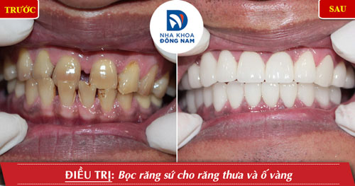 bọc sứ răng bọc sứ răng