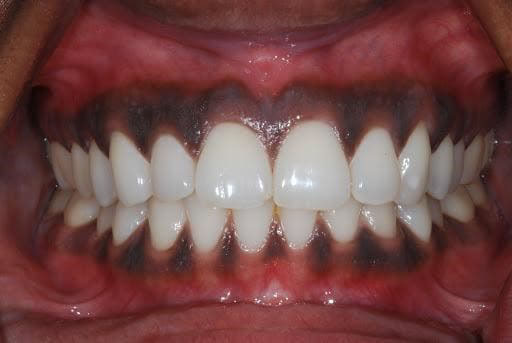 cách trị nướu răng bị đen