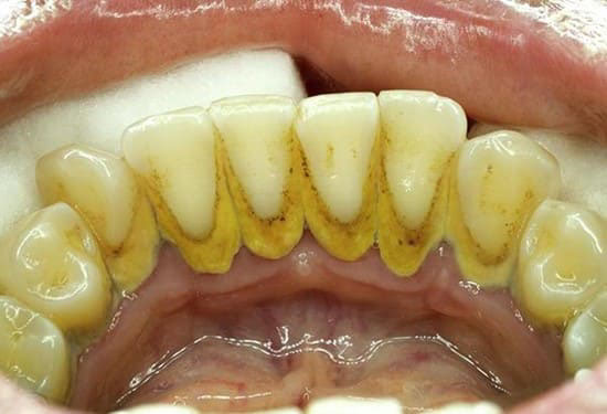 Cao răng là những mảng bám thức ăn tích tụ lâu ngày gây vôi hóa