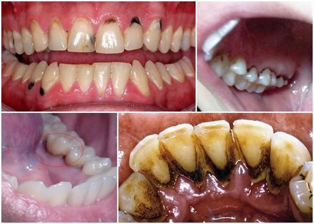 Chân răng bị đen - Nguyên nhân và cách chữa trị hiểu quả