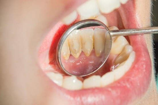 Giai đoạn đầu cao răng thường có màu vàng nhạt