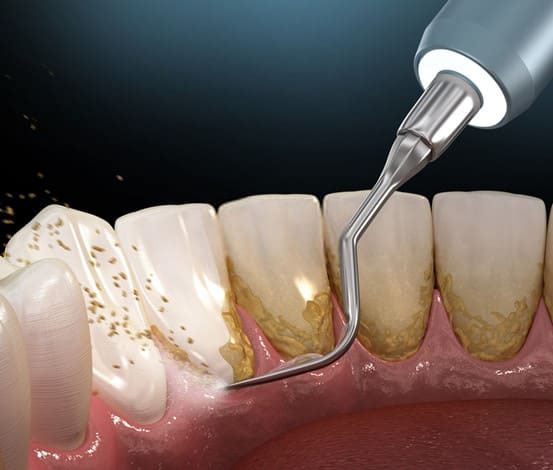 Lấy cao răng là phương pháp điều trị đầu tiên được hầu hết các nha khoa lựa chọn để điều trị hôi miệng