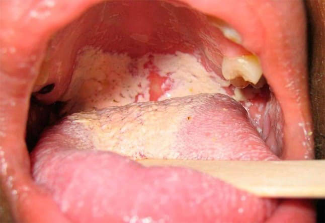 lưỡi bị trắng là biểu hiện của bệnh gì