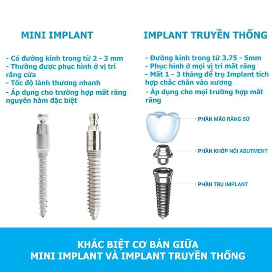 Mini Implant có đường kính trong nhỏ hơn so với Implant truyền thống