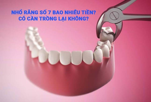 nhổ răng số 7