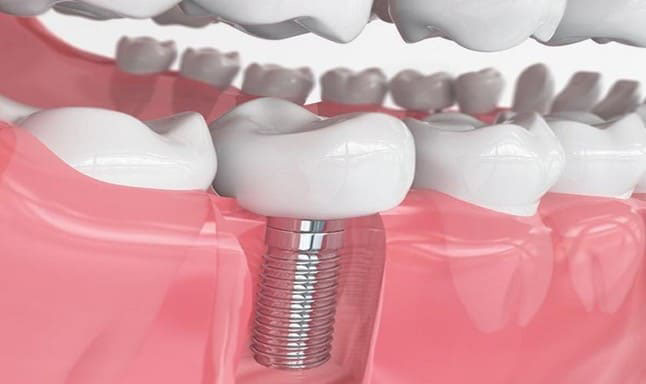 Trồng răng Implant là giải pháp tối ưu khi bị mất răng số 7