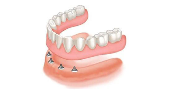 Ưu điểm của Mini Implant là có thể phục hình răng giả ngay sau khi cấy ghép