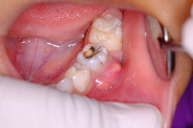 áp xe chân răng