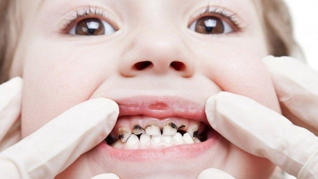 Sâu răng ở trẻ em: Nguyên nhân, dấu hiệu và cách điều trị hiệu quả