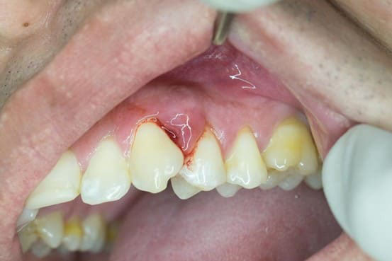 bựa răng