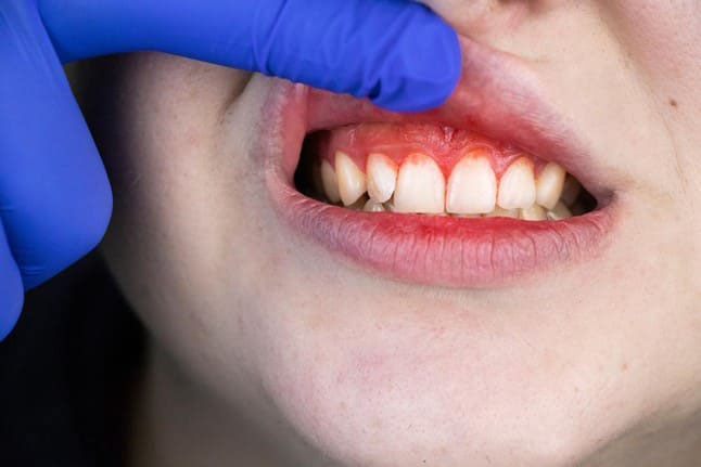 cách dùng chỉ nha khoa cho răng hàm