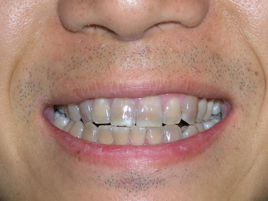 giá bọc răng sứ cercon zirconia