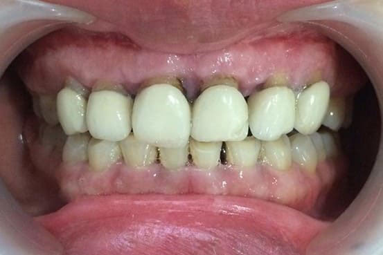 bọc răng sứ kim loại thường
