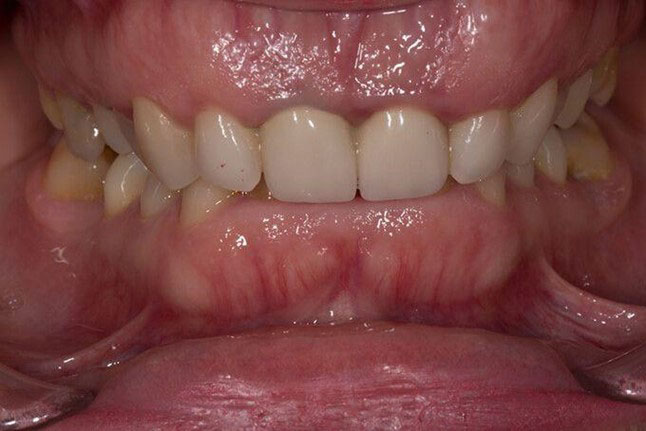 khớp cắn lý tưởng