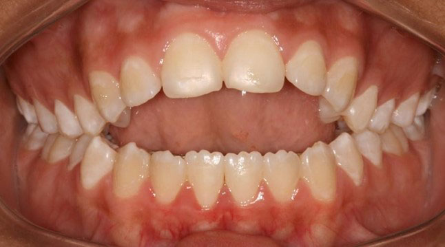khớp cắn răng chuẩn
