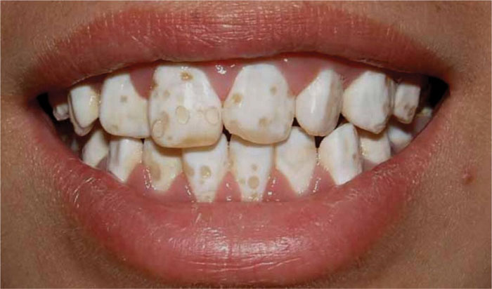 Tình trạng thiểu sản men răng 