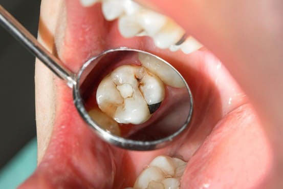 nhức răng sau khi trám