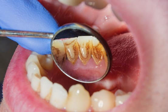 Những người mắc bệnh lý về răng miệng cần hạn chế tẩy trắng nếu chưa được điều trị dứt điểm