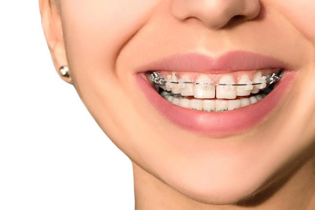 Niềng răng giúp khắc phục răng thưa hiệu quả lâu dài