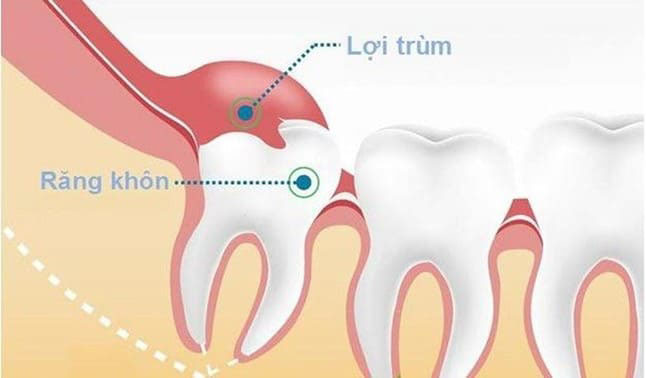 nướu răng bị sưng