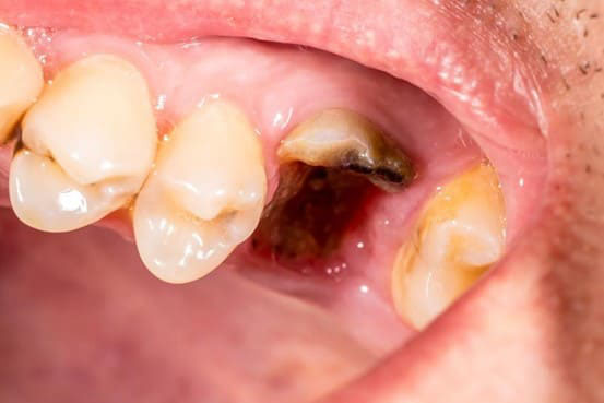 răng đau nhức có nhổ được không