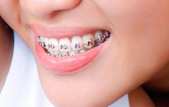 răng quặp là gì
