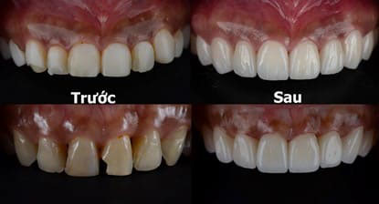 Răng sứ bị hư hoàn toàn có thể thay răng sứ mới