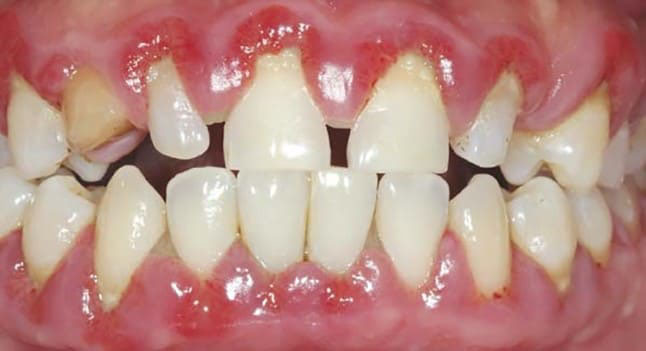 Răng thưa ảnh hưởng nguy hiểm đến sức khỏe răng miệng