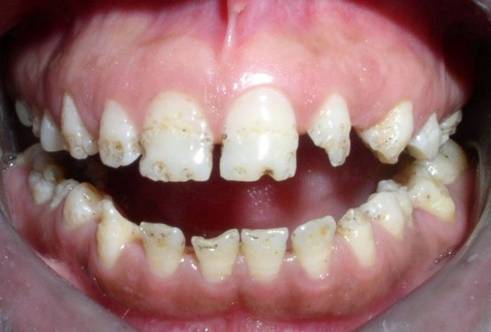 Răng xuất hiện nhiều vết lõm màu vàng nhạt hoặc nâu sẫm