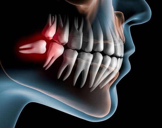 Sưng nướu răng trong cùng có thể là biểu hiện của bệnh mọc răng khôn