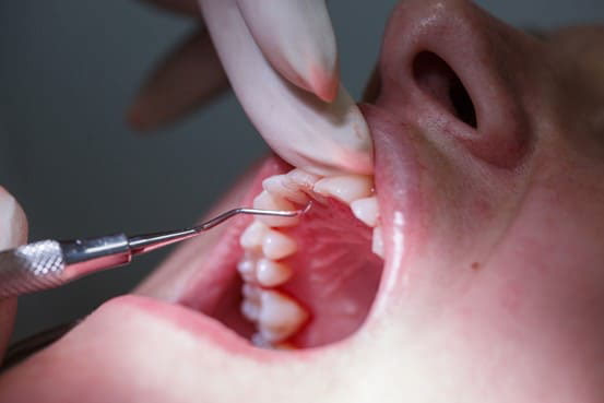 Thực hiện cạo vôi răng định kỳ tại nha khoa