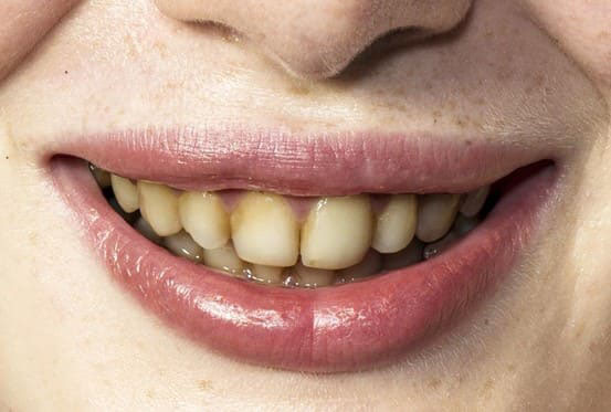 Thực hiện tẩy trắng răng khi răng bị ố vàng do nhiễm màu thực phẩm