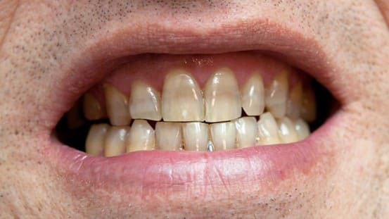 Tình trạng răng bị nhiễm Tetracycilne