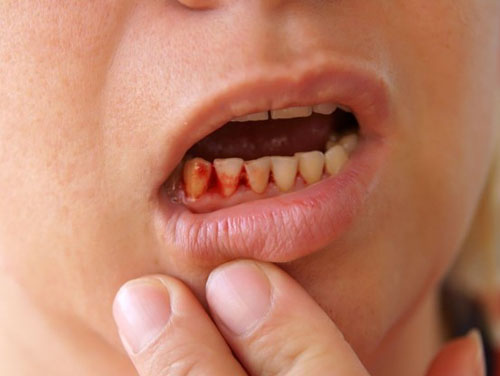 Chảy máu kéo dài sau khi nhổ răng