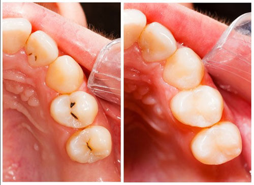 Chi phí trám răng phụ thuộc vào vật liệu trám, số lượng răng cần trám và tình trạng răng miệng