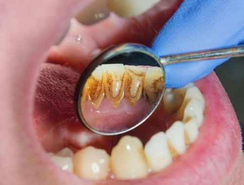 Không lấy cao răng định kỳ là một trong những nguyên nhân gây sâu răng