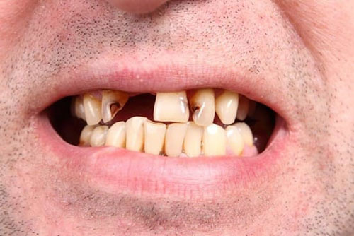 Mất răng cửa do sâu răng không điều trị