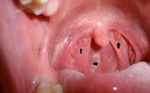 Nổi hạch ở cổ là một trong những biểu hiện của ung thư vòm họng