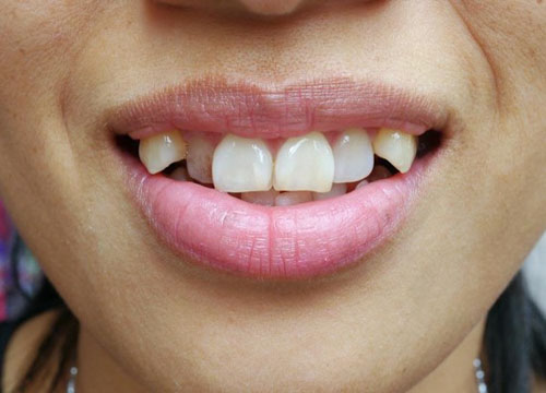 Răng khểnh mọc lệch nghiêm trọng sẽ làm ảnh hưởng đến sức khỏe răng miệng