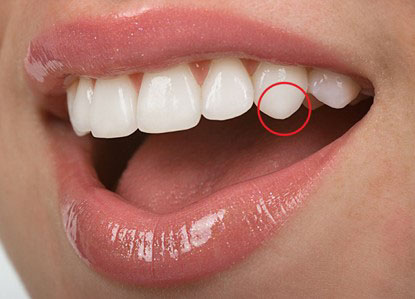 Răng nanh là chiếc răng số 3 trên cung hàm