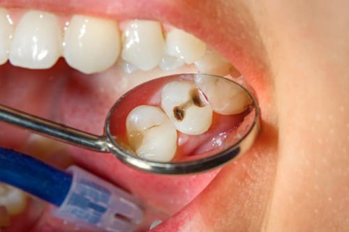 Sâu răng là sự xuất hiện của những lỗ hổng trên bề mặt răng